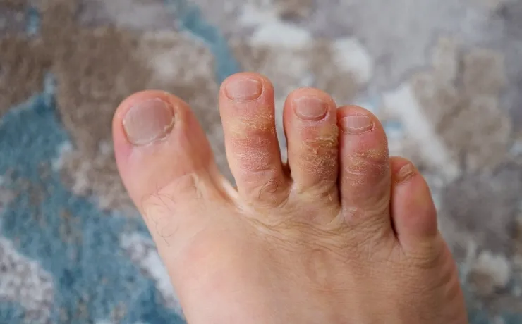 How to Eliminate Foot Fungus for Good: Tips from Experts
