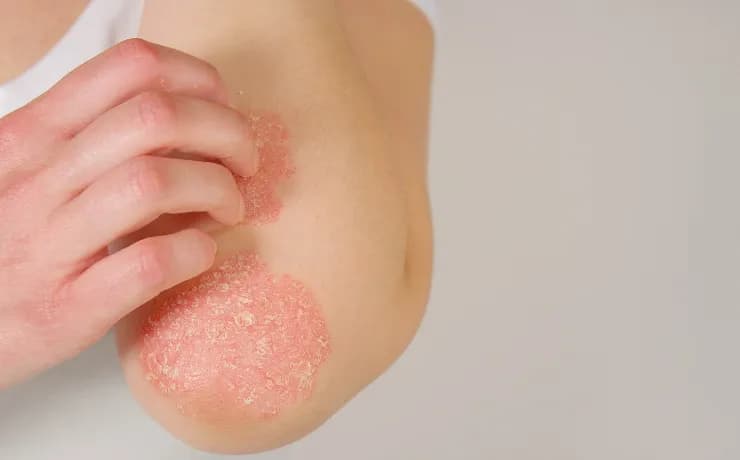 Managing Psoriasis Flare-Ups with Over-the-Counter Solutions